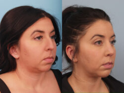 before and after rhinoplasty
