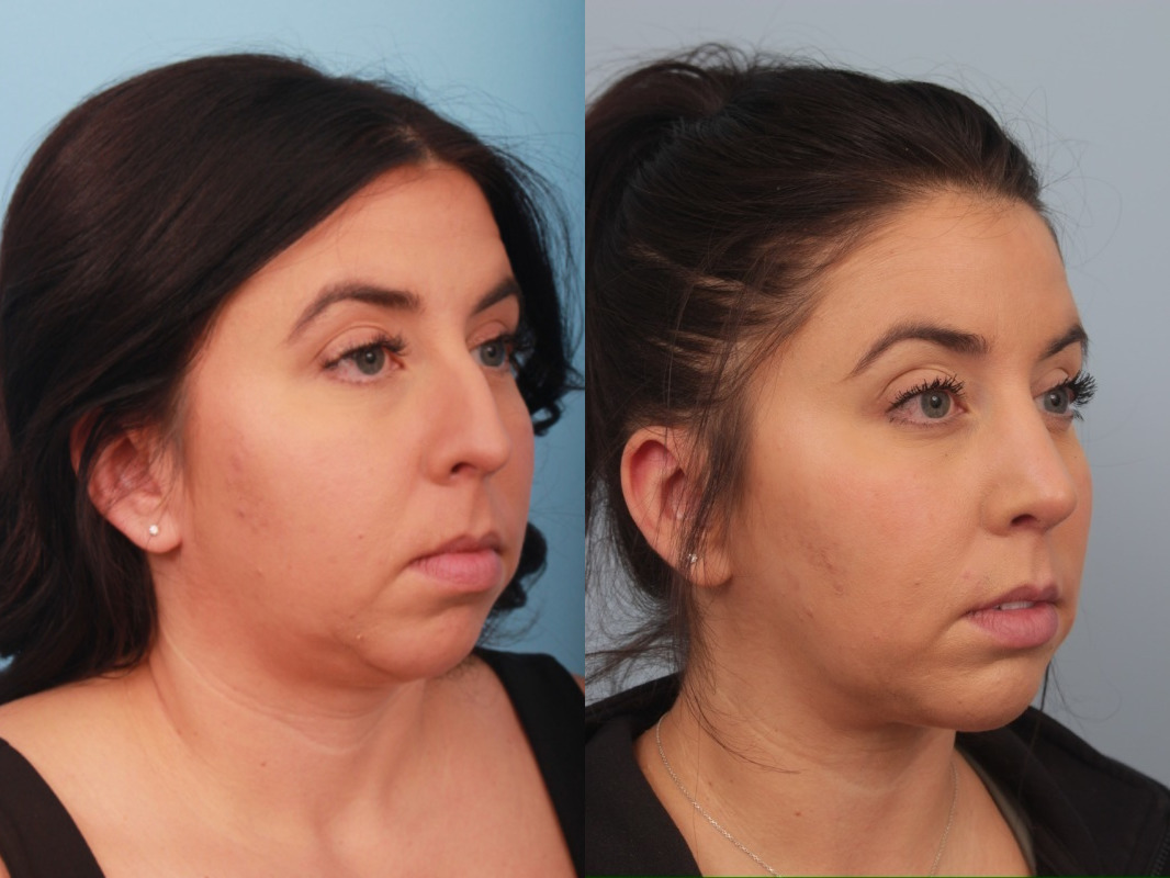 before_after_img