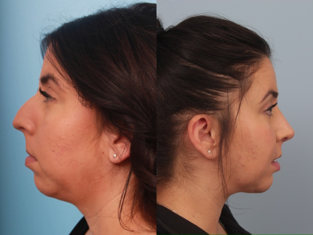 before_after_img