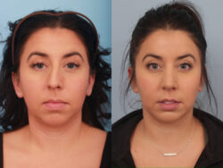before and after rhinoplasty