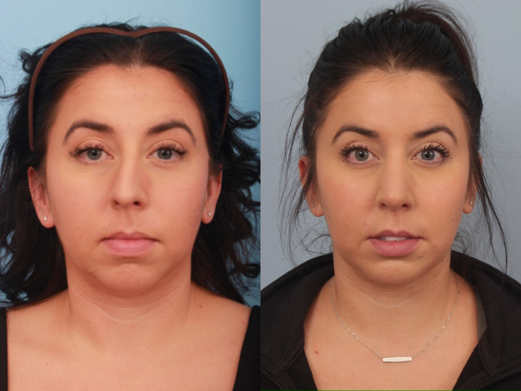before_after_img