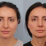 FacesFirst-Gallery-Rhinoplasty-132-Front