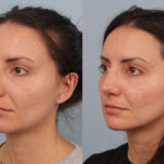 FacesFirst-Gallery-Rhinoplasty-132-Left-OBL