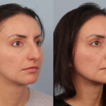 FacesFirst-Gallery-Rhinoplasty-132-Right-OBL