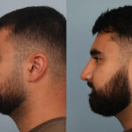 FacesFirst-Gallery-Rhinoplasty-133-Left