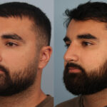 FacesFirst-Gallery-Rhinoplasty-133-Left-OBL