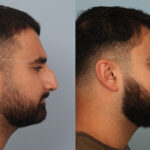 FacesFirst-Gallery-Rhinoplasty-133-Right