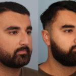 FacesFirst-Gallery-Rhinoplasty-133-Right-OBL