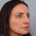 rhinoplasty-after