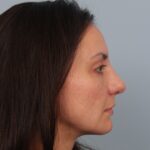 rhinoplasty-after