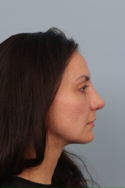 after rhinoplasty