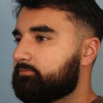 rhinoplasty-after