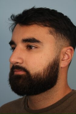 after rhinoplasty
