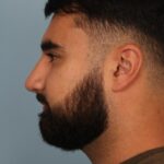 rhinoplasty-after