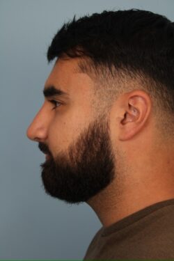 after rhinoplasty