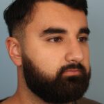 rhinoplasty-after