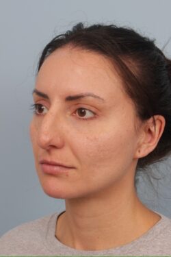 before rhinoplasty