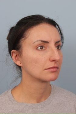 before rhinoplasty