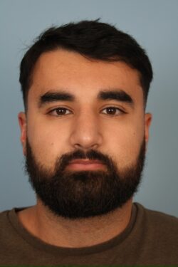 before rhinoplasty