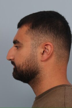 before rhinoplasty