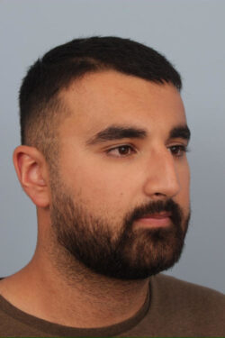 before rhinoplasty