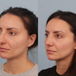 rhinoplasty-merged