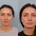 rhinoplasty-merged