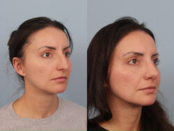 before and after rhinoplasty