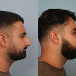 rhinoplasty-merged