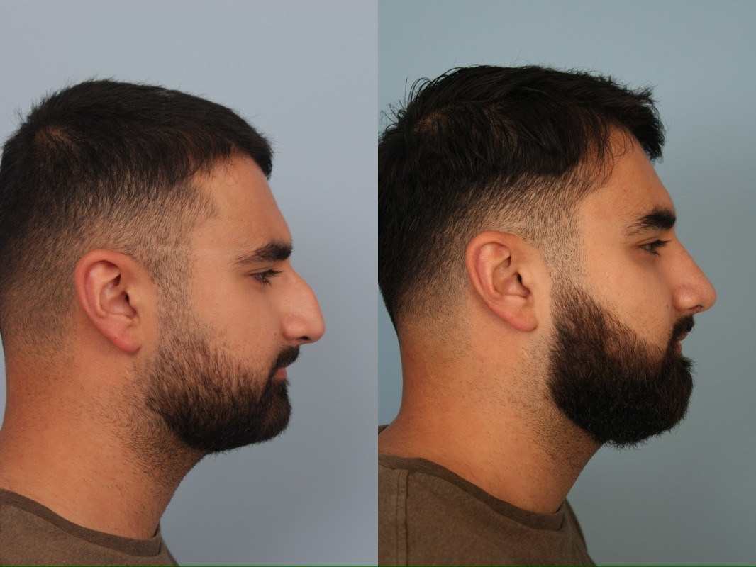 before_after_img