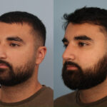 rhinoplasty-merged