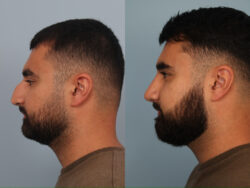 before and after rhinoplasty