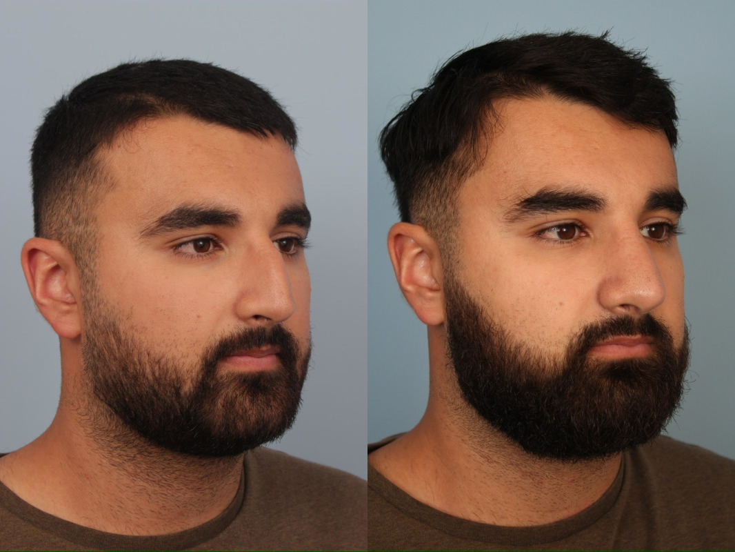 before_after_img