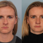 FacesFirst-Gallery-Rhinoplasty-134-Front