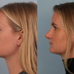 FacesFirst-Gallery-Rhinoplasty-134-Left