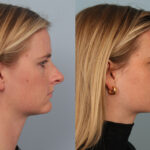 FacesFirst-Gallery-Rhinoplasty-134-Right