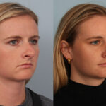 FacesFirst-Gallery-Rhinoplasty-134-Right-OBL