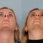 FacesFirst-Gallery-Rhinoplasty-134-Up