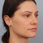 rhinoplasty-after