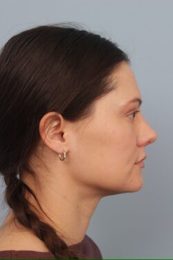 after rhinoplasty