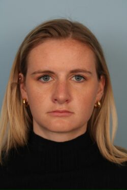 after rhinoplasty