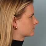 rhinoplasty-after