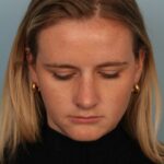 rhinoplasty-after