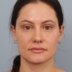 rhinoplasty-after
