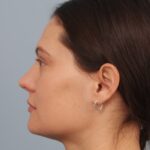 rhinoplasty-after