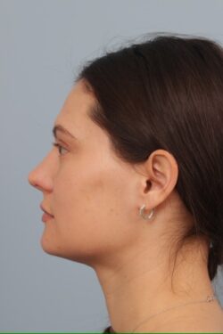 after rhinoplasty