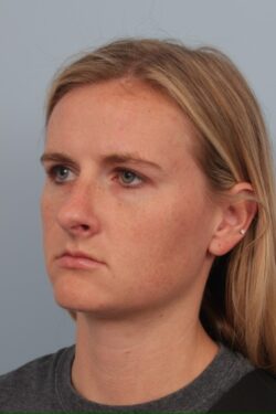 before rhinoplasty