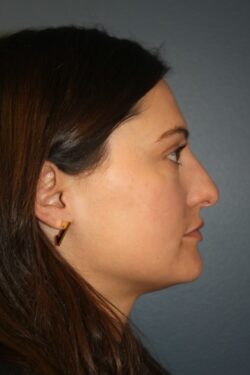 before rhinoplasty