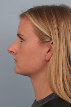 before rhinoplasty