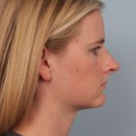 rhinoplasty-before